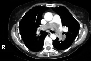 Тромбоемболія легеневих артерій<br>
Клінічний випадок