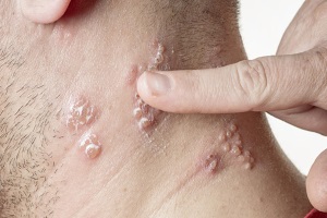 Грибковые заболевания кожи: особенности этиологии, патогенеза, клиники и лечения