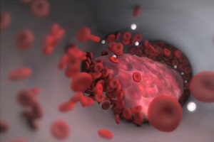 Тромбоэмболия легочной артерии: диагностическая и лечебная тактика. Взгляд терапевта