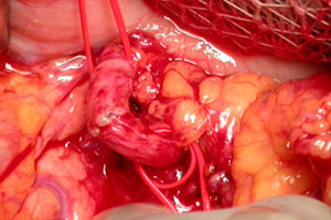 Экстренное оперативное вмешательство при разорвавшейся аневризме висцеральной артерии