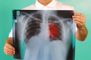 Рак легенів у поєднанні з туберкульозом