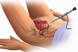 Современные малоинвазивные вмешательства на органах репродуктивной системы и тазового дна у женщин