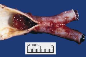 Тромбоэмболия легочных артерий в акушерско-гинекологической практике