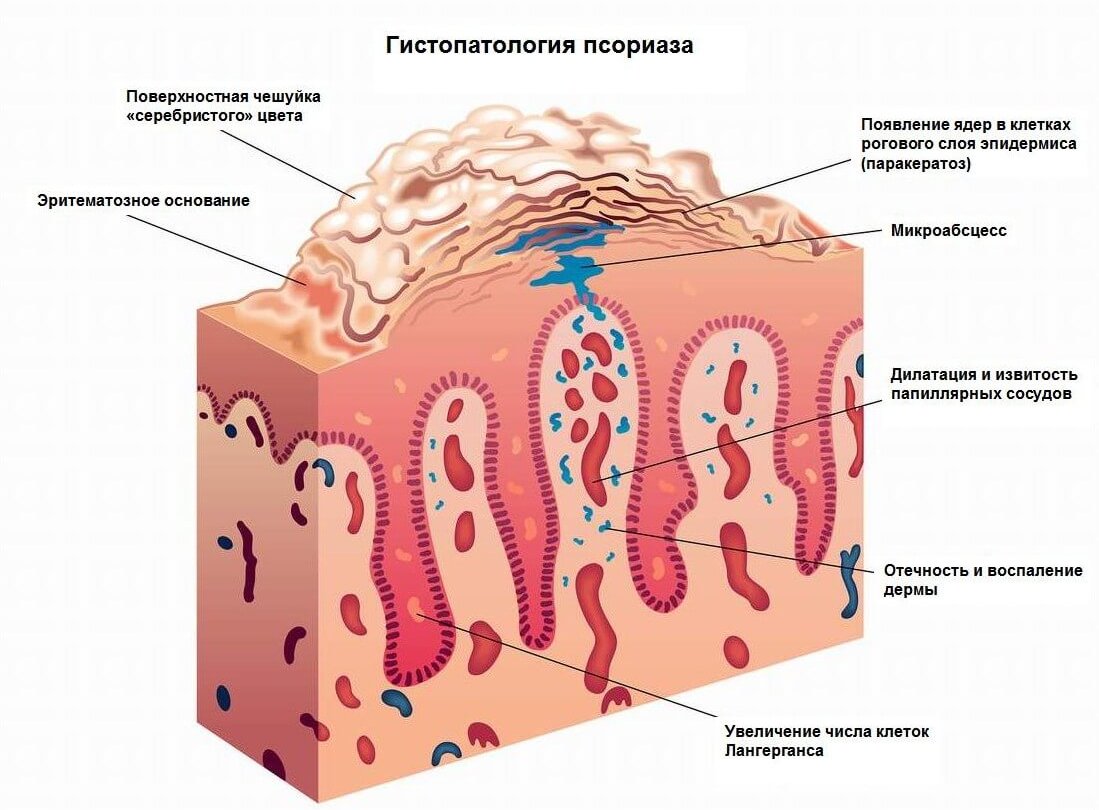 гистопатология псориаза