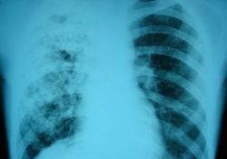 Туберкулеза на планете стало меньше – надолго ли?..