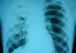 Новый препарат для лечения лекарственно-устойчивого туберкулеза показал хороший результат