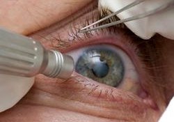 Операция по удалению катаракты: узрят не все