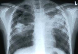 Где «прячется» средство для борьбы с лекарственно-устойчивым туберкулезом легких
