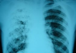 Туберкулез можно эффективно лечить старым противопаразитарным препаратом