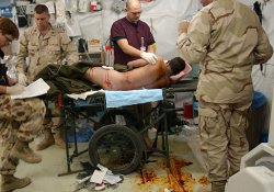 Остановить внутрибрюшное кровотечение поможет инъекция особой пены