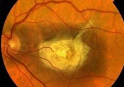Длительный прием аспирина чреват опасным заболеванием сетчатки глаза