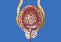 Роль тамсулозина в комплексном лечении симптомов нижних мочевых путей