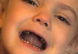 Детский стоматолог изуродовал четырехлетнюю девочку оригинальным методом лечения