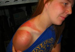 Готовимся отдыхать: 5 продуктов, которые защитят кожу от солнечных ожогов