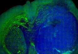 Лазер стал средством визуализации злокачественных опухолей мозга