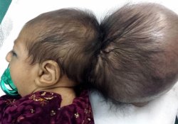 Уникальное лечение: в Афганистане «гильотинировали» младенца