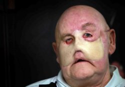 Рак сосудов лица: маленький прыщик привел к потере щек, носа и скул