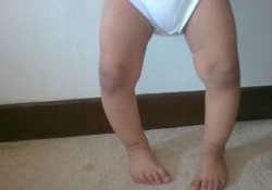 Возвращение рахита: современные источники болезни из прошлого