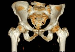 Англия: искусственные кости таза не хуже настоящих