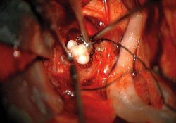 Тайна врожденных опухолей раскрыта, или зубы в мозге