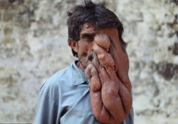 Медицина бессильна: индийский «человек-слон» опустил руки