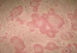 Рак кожи «обходит стороной» больных экземой
