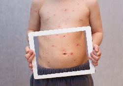 Аллергия: Ipad и никелевая сыпь