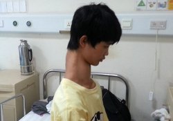 «Мальчику-жирафу» оперативно укоротят шею
