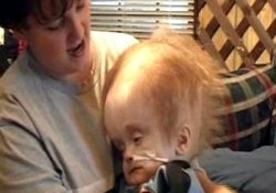 12 лет без мозга: ребенок-инвалид побил все рекорды