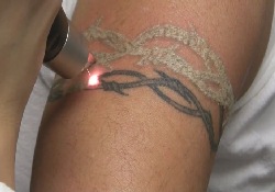 Удаление татуировки: избавление от «ошибок молодости» может вызвать рак кожи