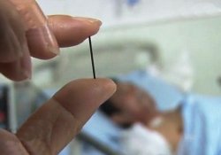 Акупунктура и ее осложнения: китаец более 40 лет жил с иглой в кишечнике
