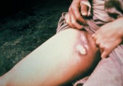 Чума убивает жителей Мадагаскара