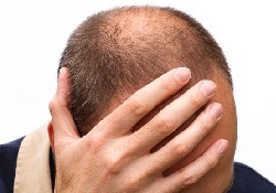 Облысение не приговор: вернуть волосы помогут компоненты иммунной системы