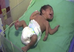 Индийские врачи успешно избавили новорожденного мальчика от третьей руки