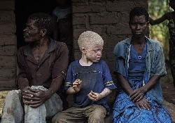 Органы африканцев-альбиносов исцеляют от болезней
