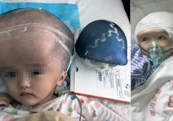 Врачи КНР излечили девочку от тяжелой гидроцефалии и «подарили» ей новый череп
