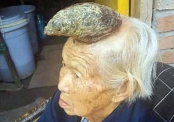 Быстро отрастающий «рог» на голове старушки из Китая очень озадачил врачей