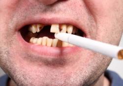 Курильщикам грозит не только пожелтение зубов, но и их выпадение