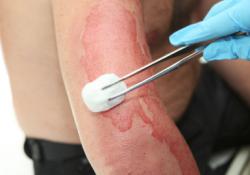 Ученые предлагают лечить инфекции ожоговых ран… разбавленным уксусом