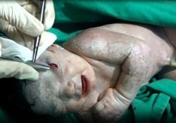 Сирийские хирурги спасли жизнь девочки, раненной осколком в утробе матери