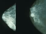 Найден новый генетический маркер рака груди