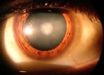Найден ключ к загадке возникновения катаракты