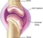 Операция на колене при артрите нецелесообразна