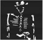 Чахотке более 9 тысяч лет