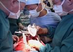 В Швеции имплантировали первое временное полностью искусственное сердце