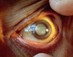 Ранняя диагностика катаракты с помощью космических технологий