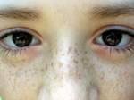 Веснушки и  родинки предупреждают о раке глаза