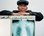Больные туберкулезом могут лишиться слуха из-за лечения