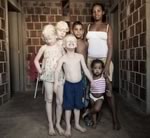 Трое из пятерых детей чернокожей пары – альбиносы!