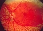 Диабетическую ретинопатию лучше всего лечить при помощи лазера